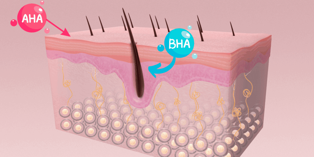  Ilustração mostrando a ação do ácido glicólico na camada superficial da pele para renovação celular. como o ácido salicílico penetra nos poros para dissolver o sebo e combater cravos.